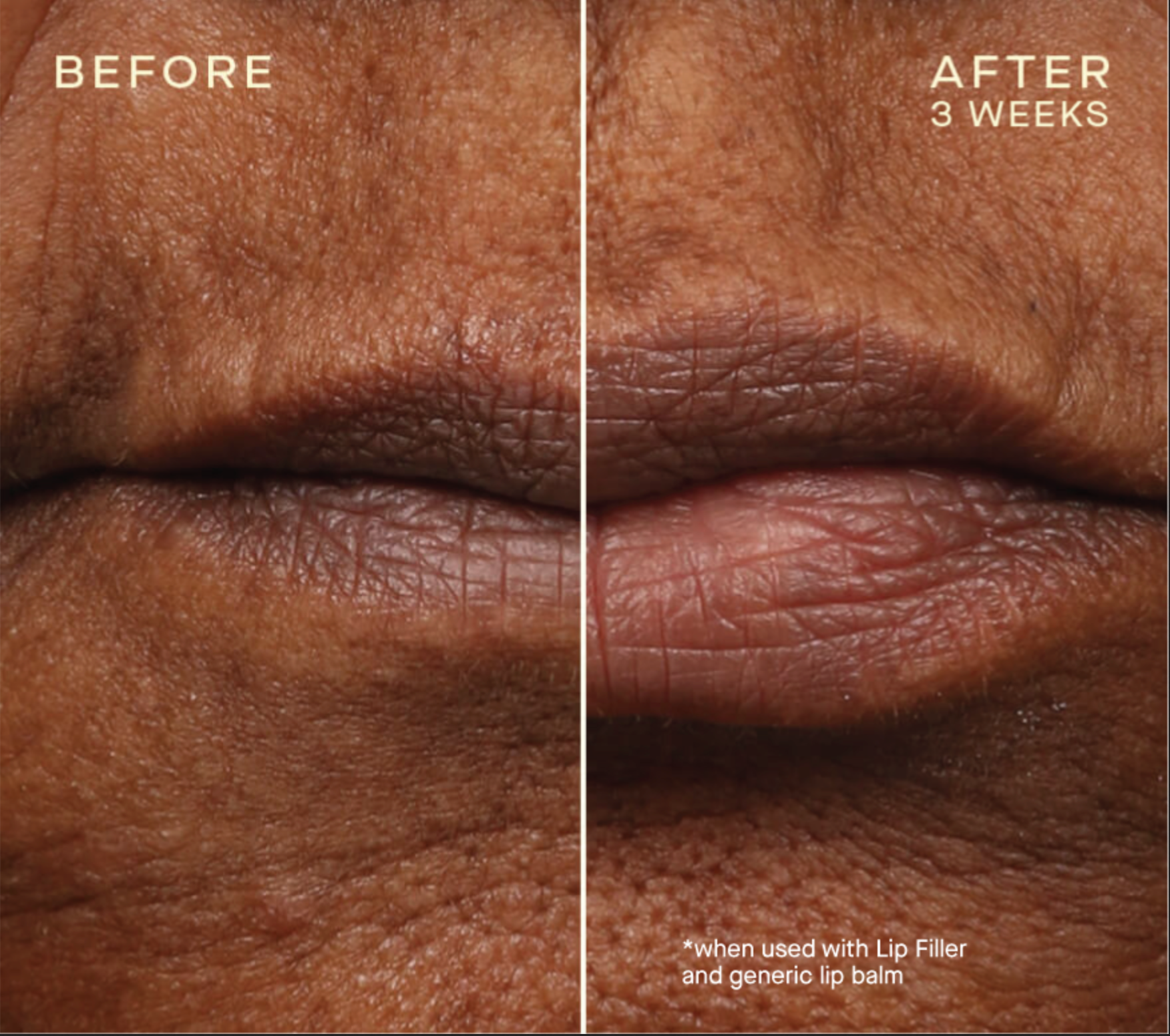 Lip Filler with Tiered-Release Vesicle™ Technology