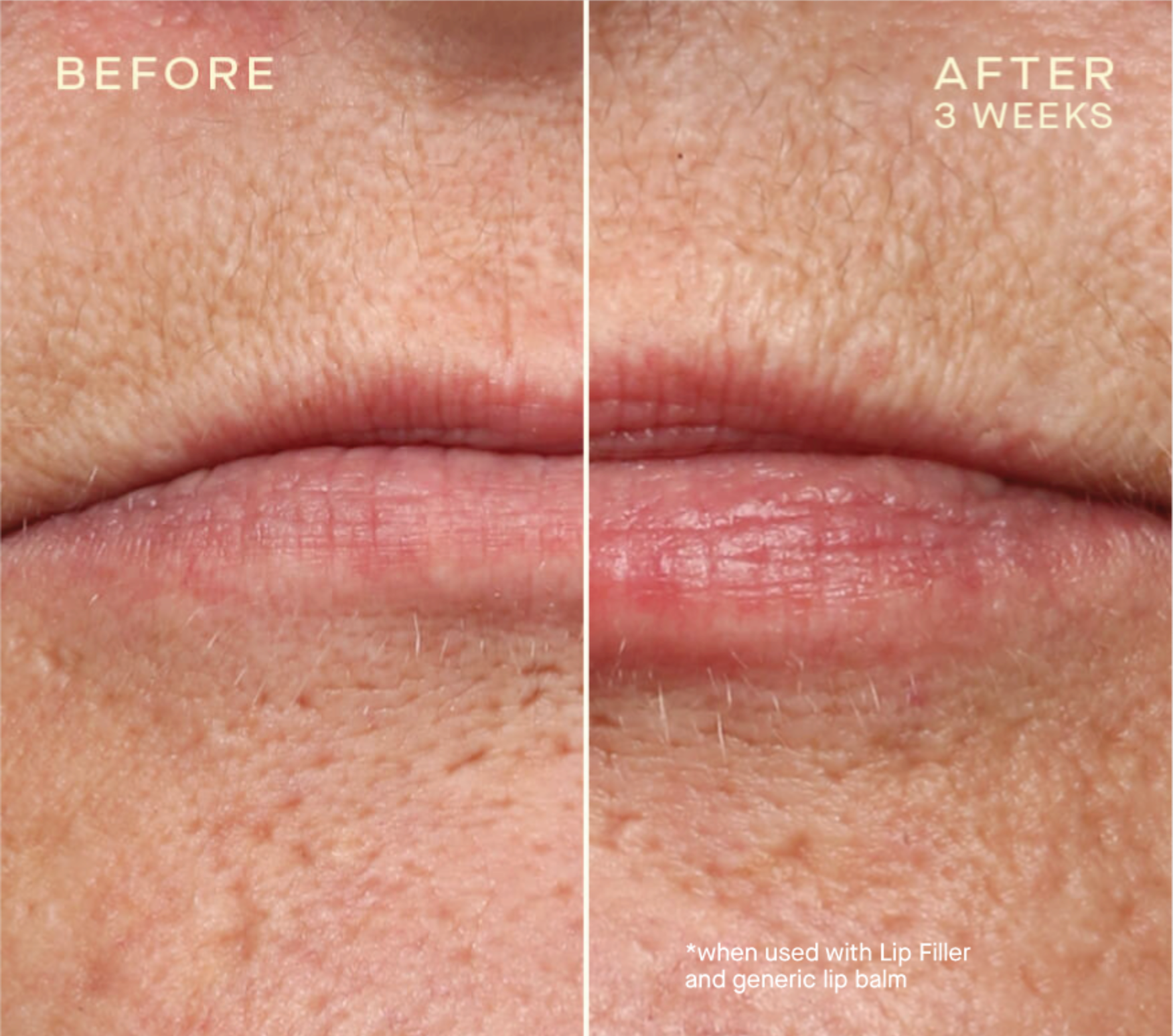 Lip Filler Refill with Tiered-Release Vesicle™ Technology