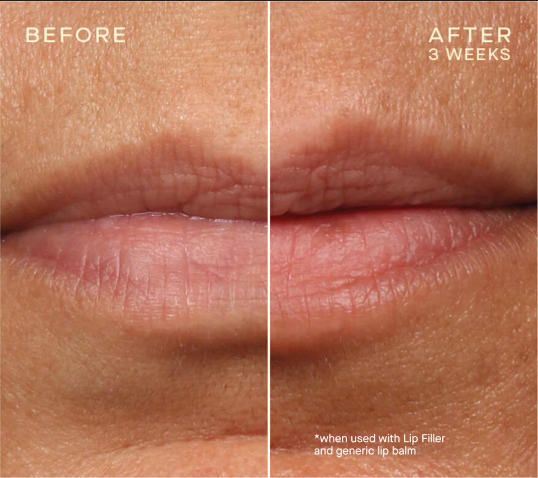 Lip Filler Refill with Tiered-Release Vesicle™ Technology