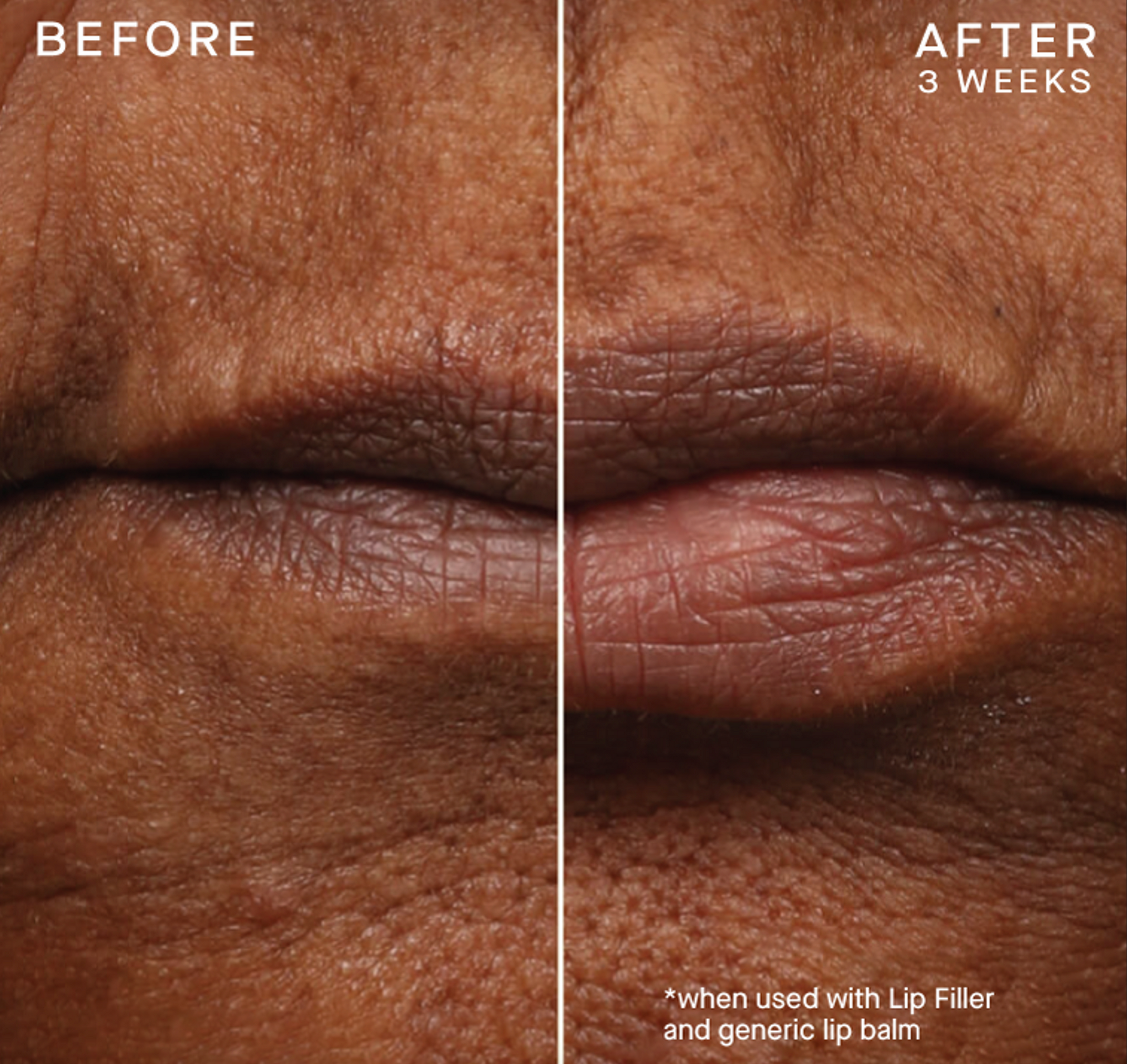 Lip Filler Refill with Tiered-Release Vesicle™ Technology