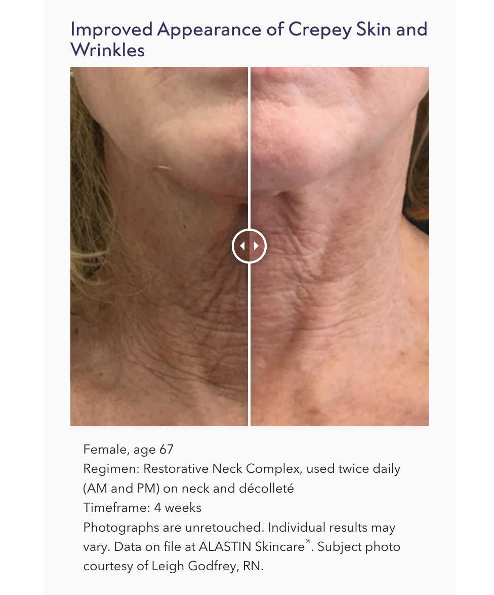 Restorative Neck Complex with TriHex Technology®